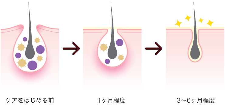 ニキビ ニキビ知らずの肌へ。治っても、くり返してしまう「ニキビの解決法