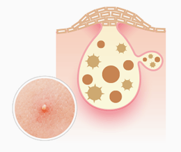 大人ニキビ